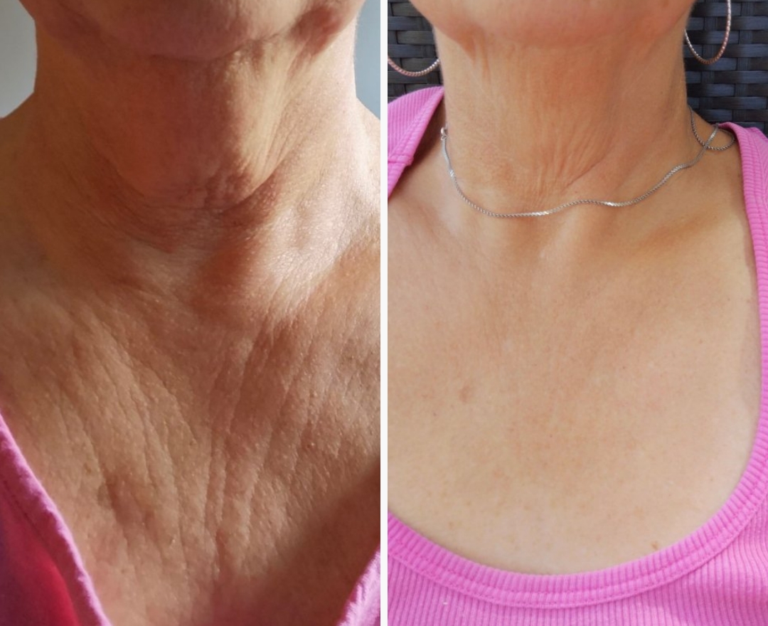 Neora before and after result