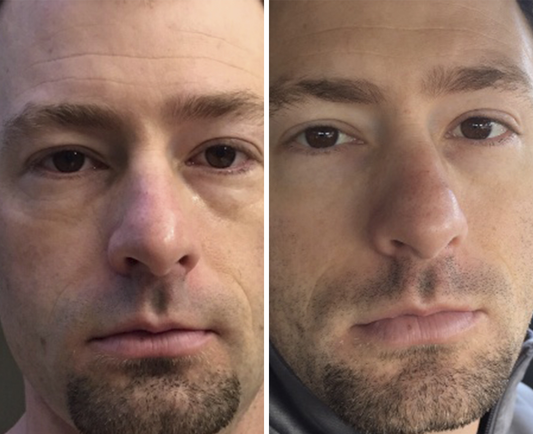 Neora before and after result