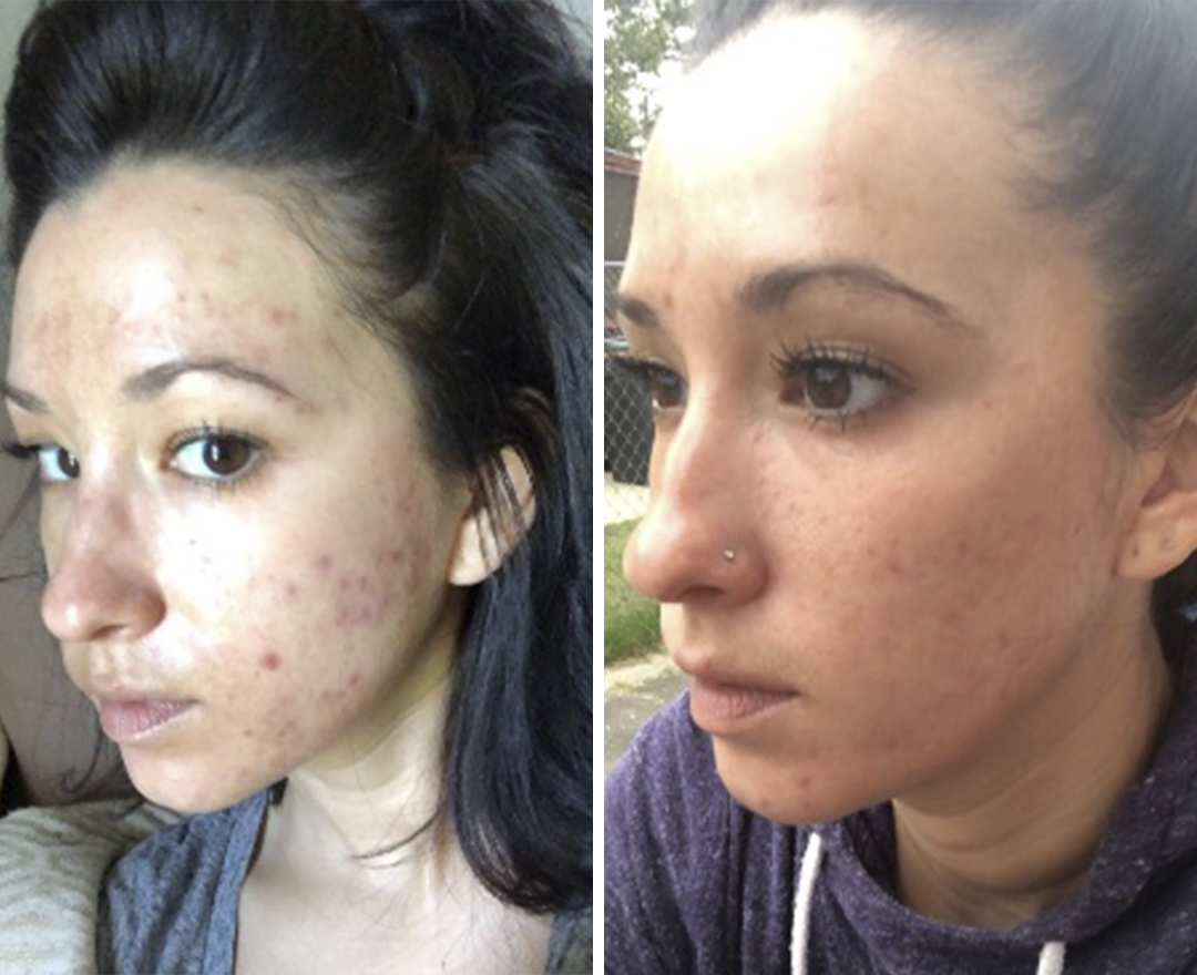 Neora before and after result