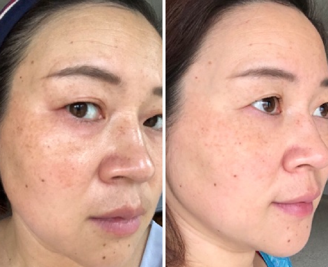 Neora before and after result